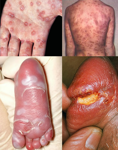 Infection-Complication-1.jpg